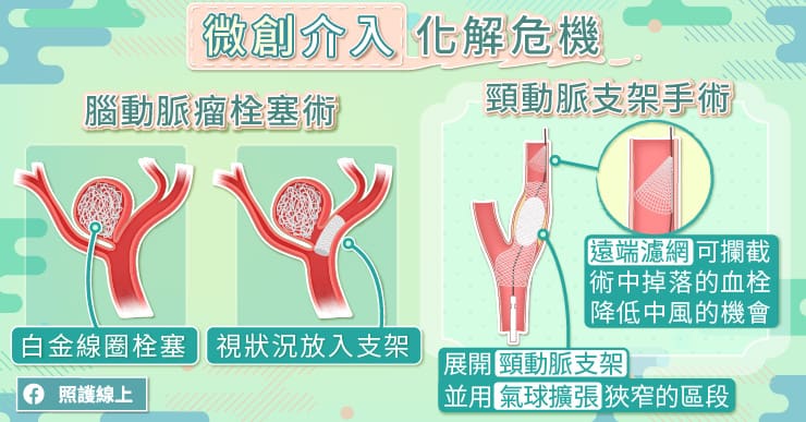 頸動脈支架，拓寬頸動脈