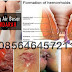 Gambar Benjolan Wasir Menahun Pada Perempuan thumbnail