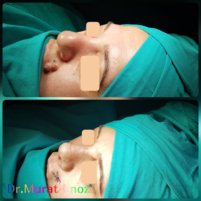 Crooked Nose Aesthetic, Nevus Excision From Lip,caudal septal dislocation, Nose Deformity,Complicated Nose Surgery