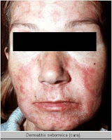 Dermatitis seborreica