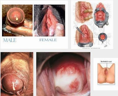 Obat Keluar Cairan Nanah Dari Alat Vital