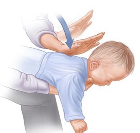 heimlich manevrası bebek