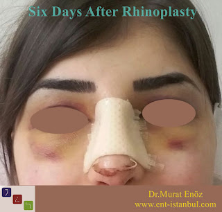 Six Days After Rhinoplasty - Healing