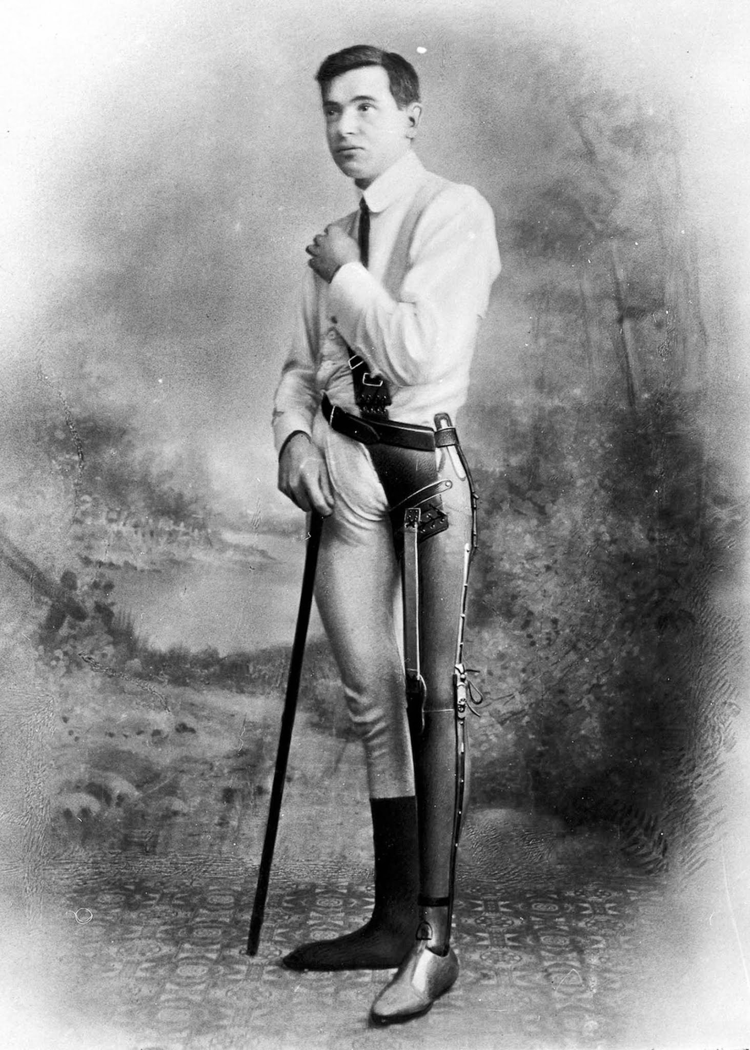 The extraordinary early prostheses made by James Gillingham  1900 - 51