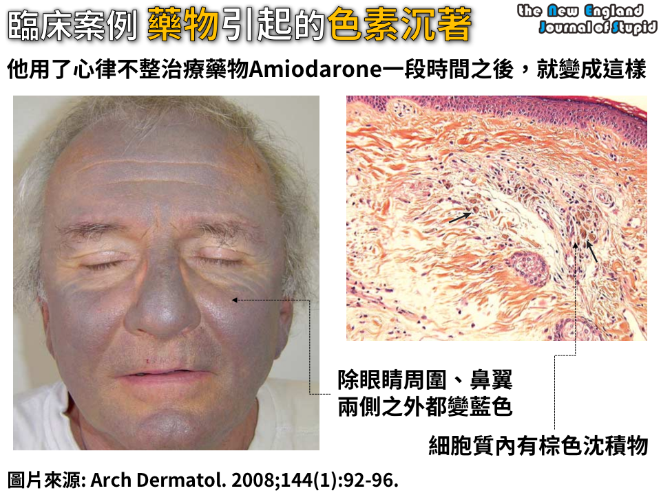 臨床病例 Amiodarone引起的皮膚色素沉著 (BlueGray Hyperpigmentation After Amiodarone