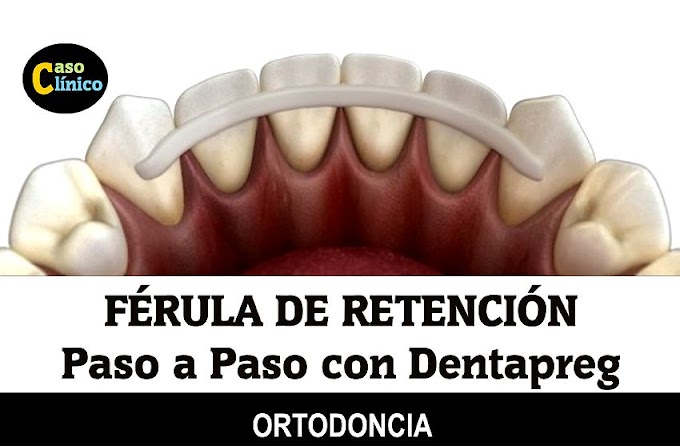 FÉRULA DE RETENCIÓN: Paso a Paso con Dentapreg