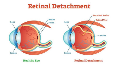 Ablasio retina