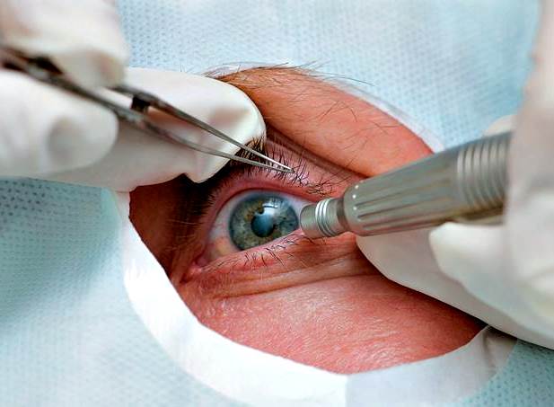 Cirugía facorefractiva lente trifocal