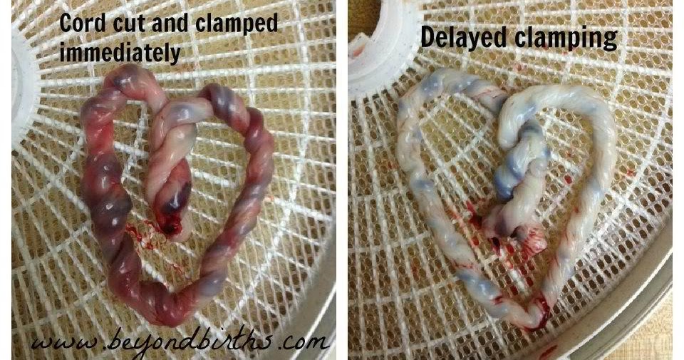 A Mother s Worth Birth Services Immediate Vs Delayed Cord Clamping a-mother-s-worth-birth-services-immediate-vs-delayed-cord-clamping