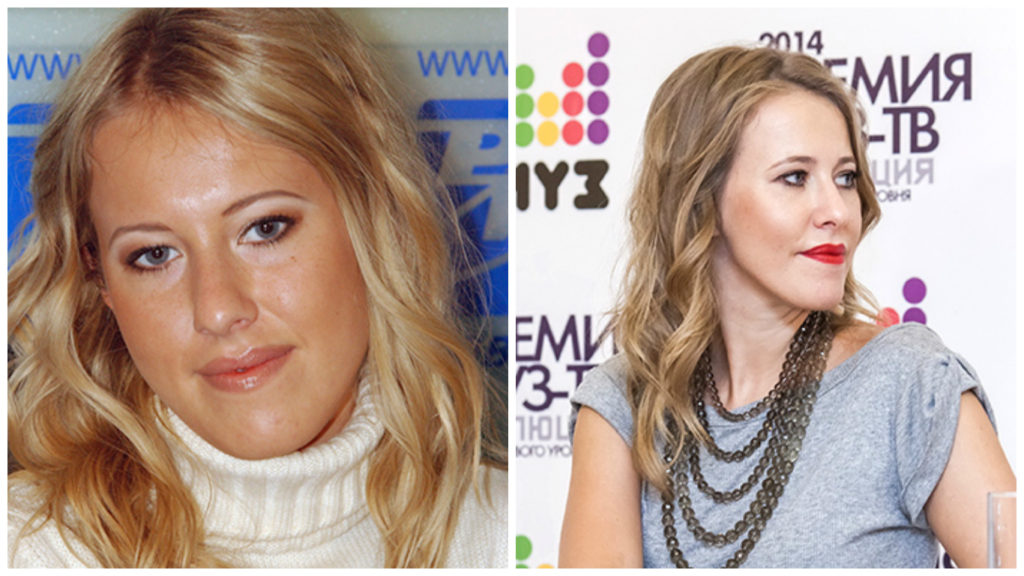Российские звезды до и после пластики носа (часть 2) Интереса ради Дзен