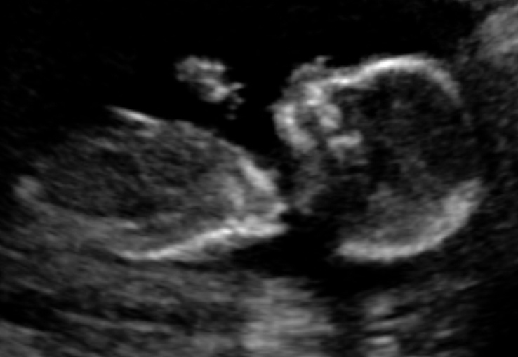 Kate & Nate Parents In Waiting 18 Week Ultrasound