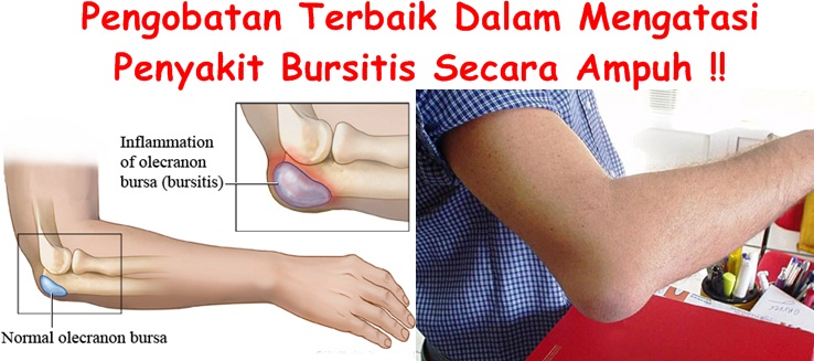 Obat Tradisional Bursitis