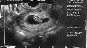 ما هو شكل كيس الحمل بعد الاجهاض