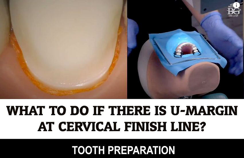 TOOTH PREPARATION What to do if there is Umargin (undercut) at