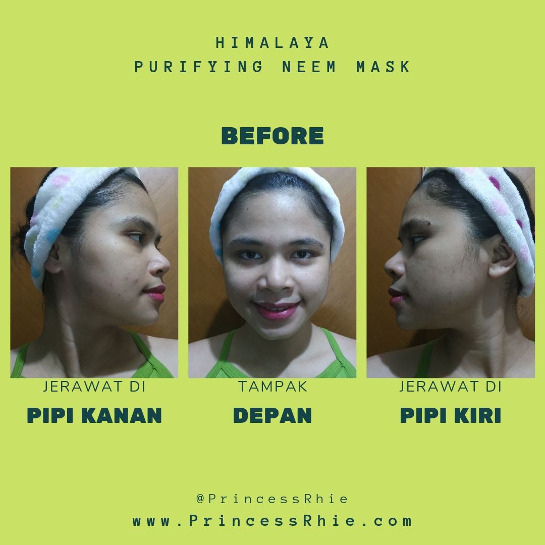 Atasi Jerawat Dengan Himalaya Purifying Neem Mask Azariatika