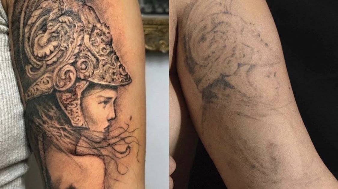 Tattoo removal NYC