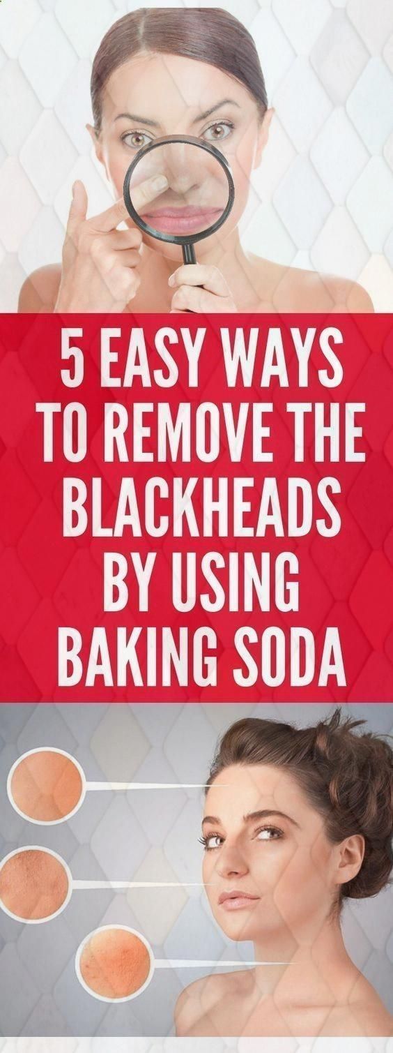 5 Easy Ways to Remove Blackheads With Baking Soda Health021viral