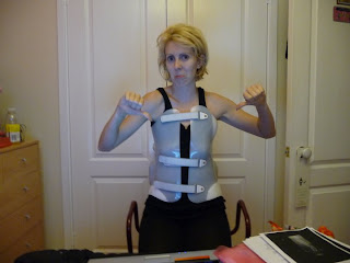 2 weeks after scoliosis surgery in my post op brace