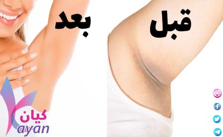 تبييض الناطق الحساسة