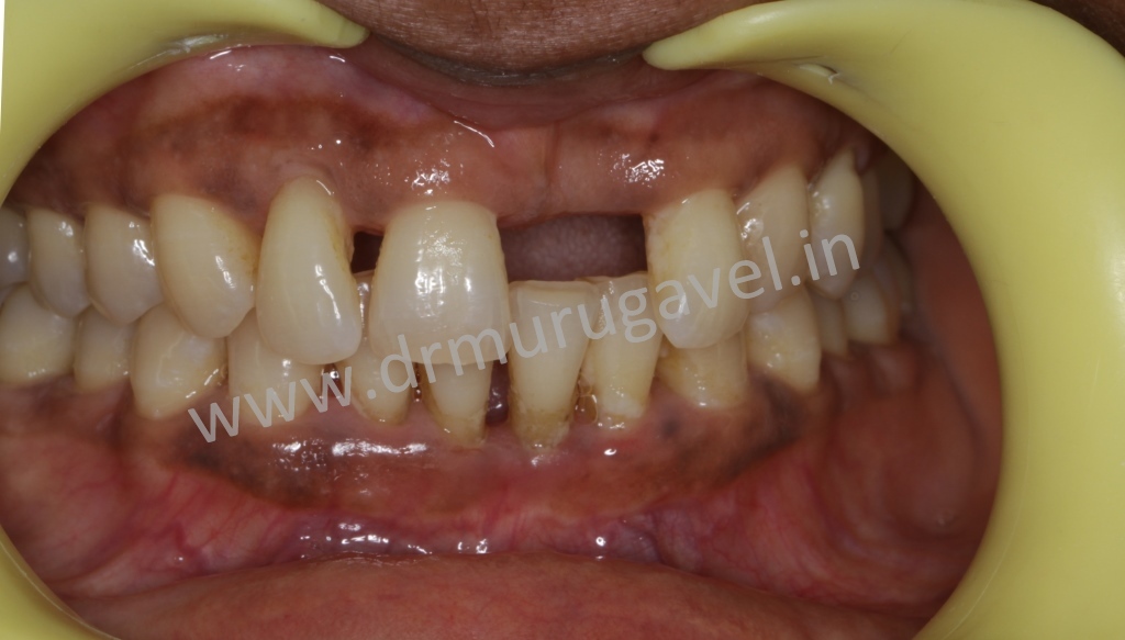 Front teeth esthetic replacement with dental implantswithout bone grafting surgeries!!