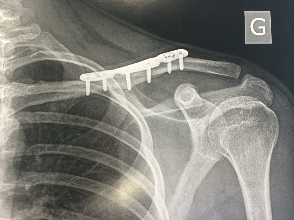 LA RÉÉDUCATION APRÈS UNE FRACTURE DE LA CLAVICULE