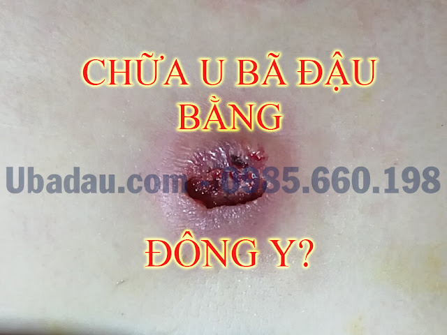 Điều trị u bã đậu bằng Đông Y có được không?