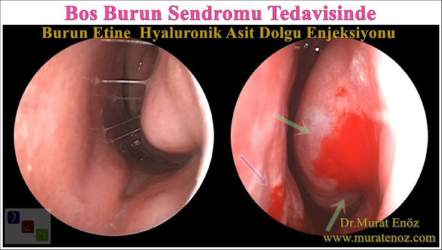 Boş burun sendromu tanımı - Boş burun sendromu belirtileri - Boş burun sendromu tedavisi - Boş burun sendromu tedavisinde Hyaluronik Asit dolgusu - Burun eti dolgusu - Treatment of Empty nose syndrome with hyaluronic acid filler - Boş burun - Geniş burun boşluğu sendromu - Burun eti büyütülmesi - Empty Nose Syndrome (ENS)