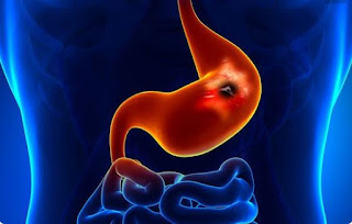 Causes of stomach cancer