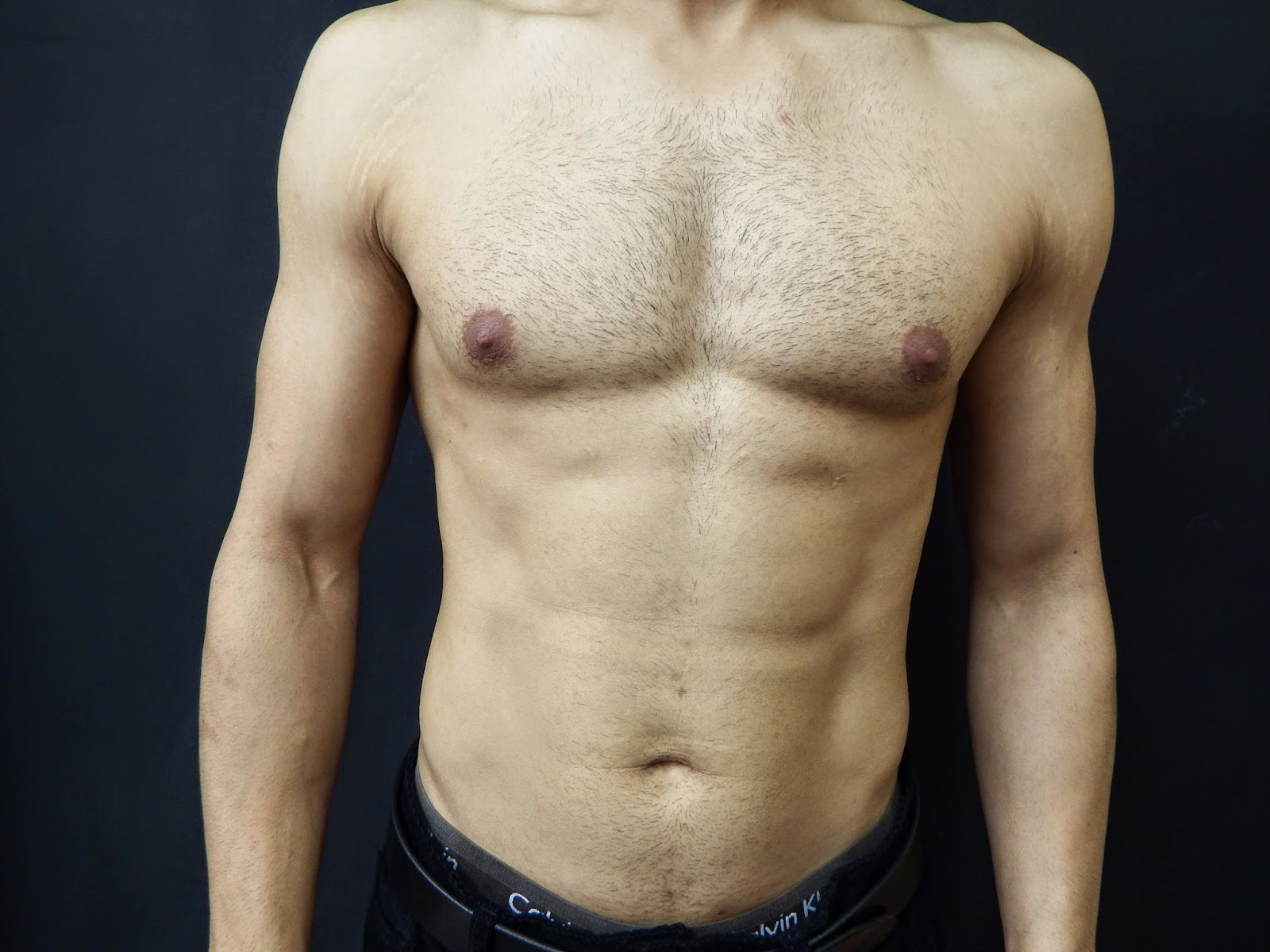 Selston Cosmetic Clinic: Vaser Lipo Chest 6 Months Later