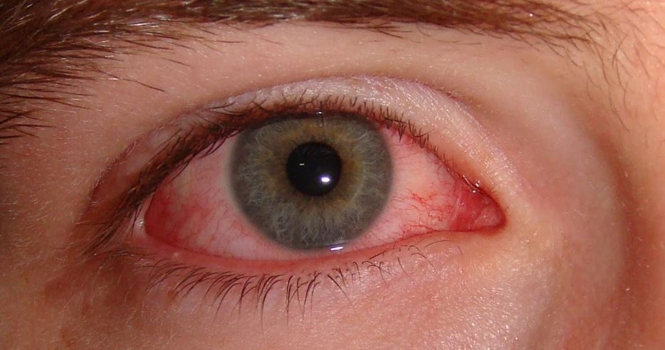 أسباب احمرار العين وعلاقة ذلك بالعدسات اللاصقة والعمل على الحاسوب طبيب نت