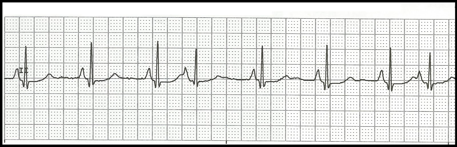 EKG Rhythm Strip Quiz 108