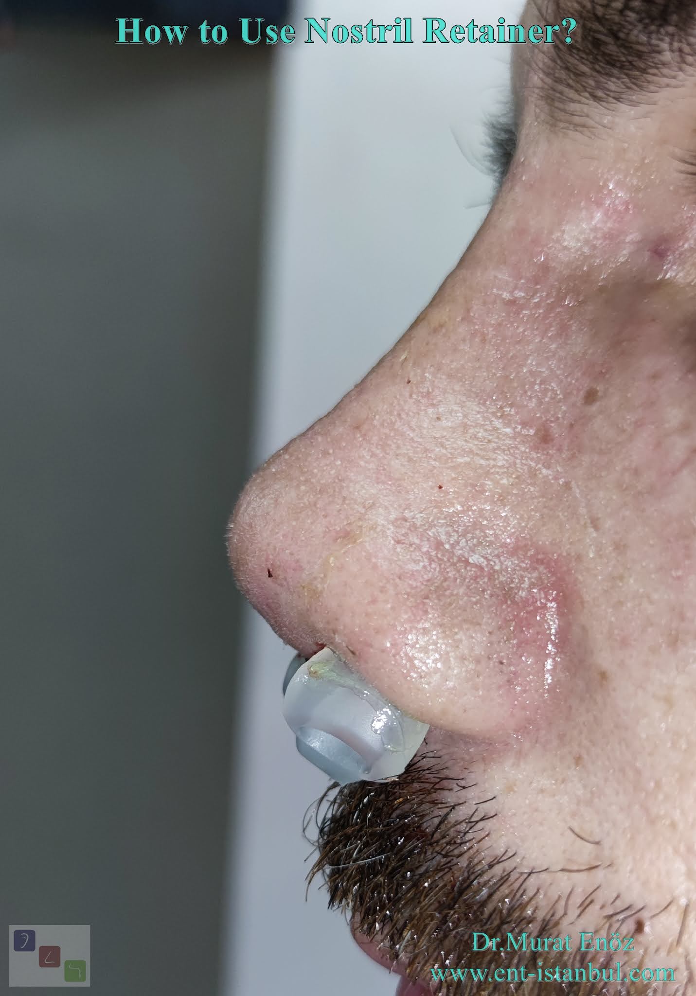 About The Nostril Retainer