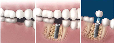 Cấy ghép răng implant ưu điểm gì?