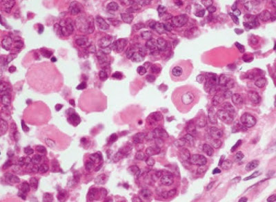 [Pathology] Atlas of Unusual Types of Thymoma | Free Medical Atlas