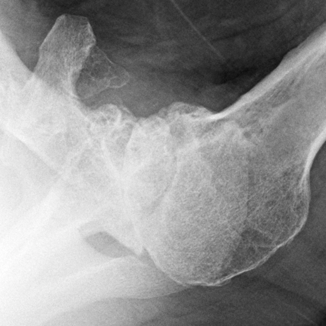 Shoulder Arthritis / Rotator Cuff Tears / Shoulder Pain Glenoid