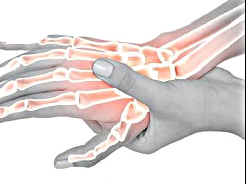 أعراض التهاب عصب اليد اليسرى