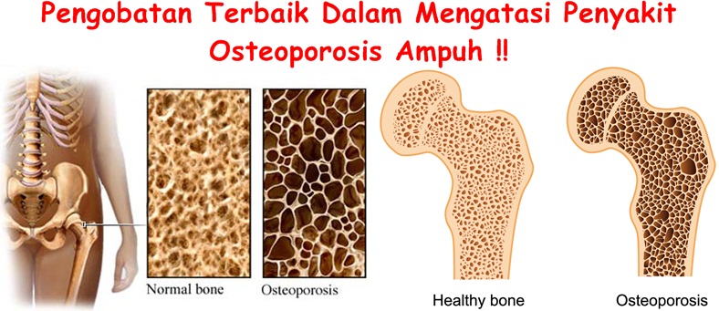 Como mejorar la osteoporosis