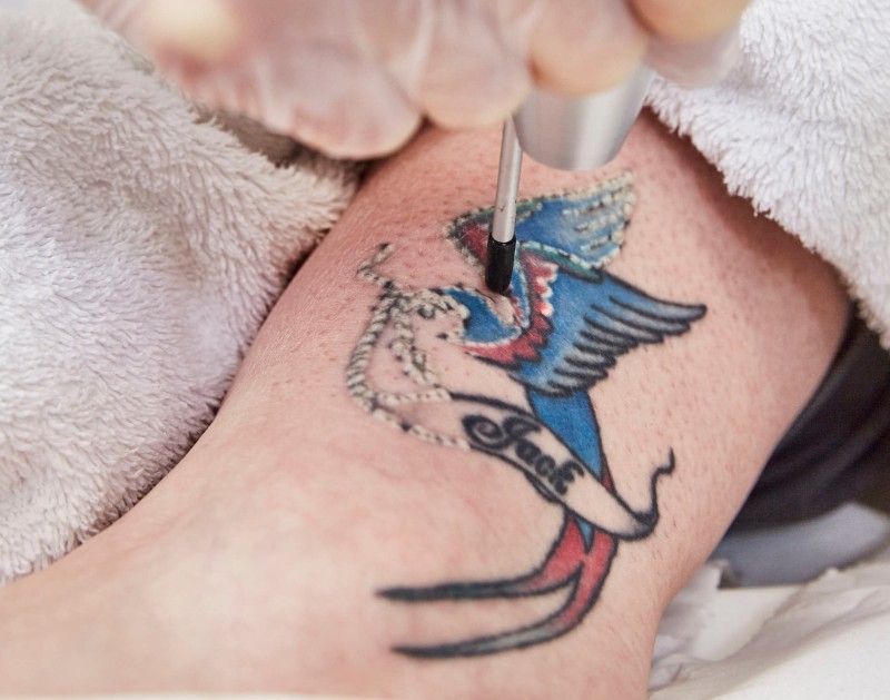 1. Natural Tattoo Removal Methods - wide 8