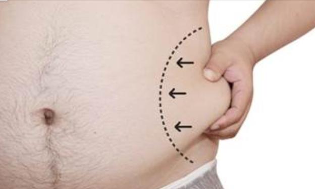 نصائح قبل القيام بإجراء شفط الدهون