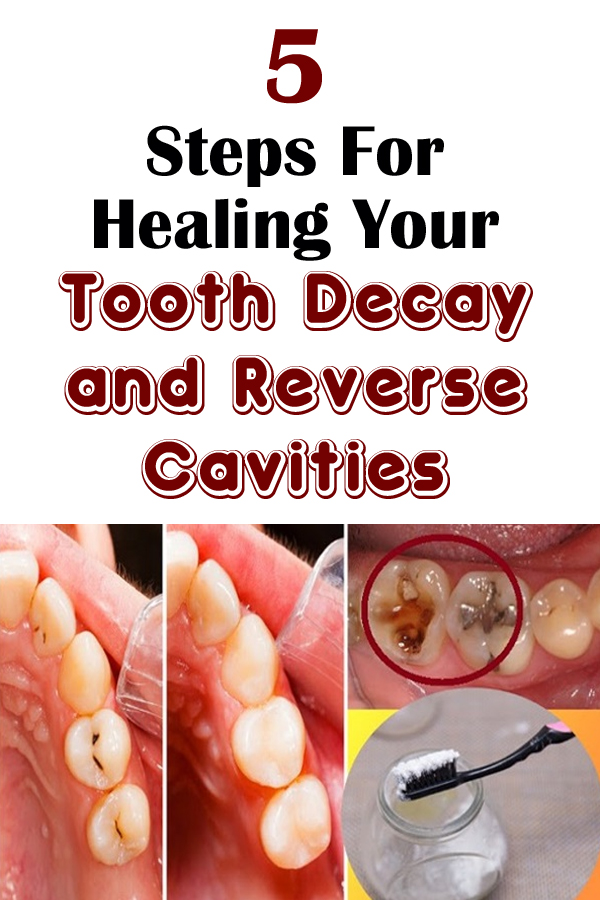 5 Steps For Healing Your Tooth Decay and Reverse Cavities