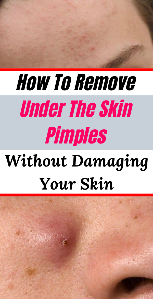 How To Remove Under The Skin Pimples Without Damaging Your Skin | Only Tips