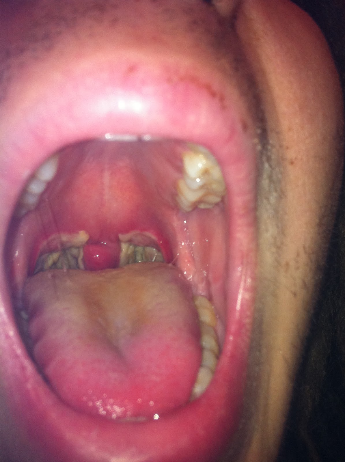 tonsillectomy-recovery