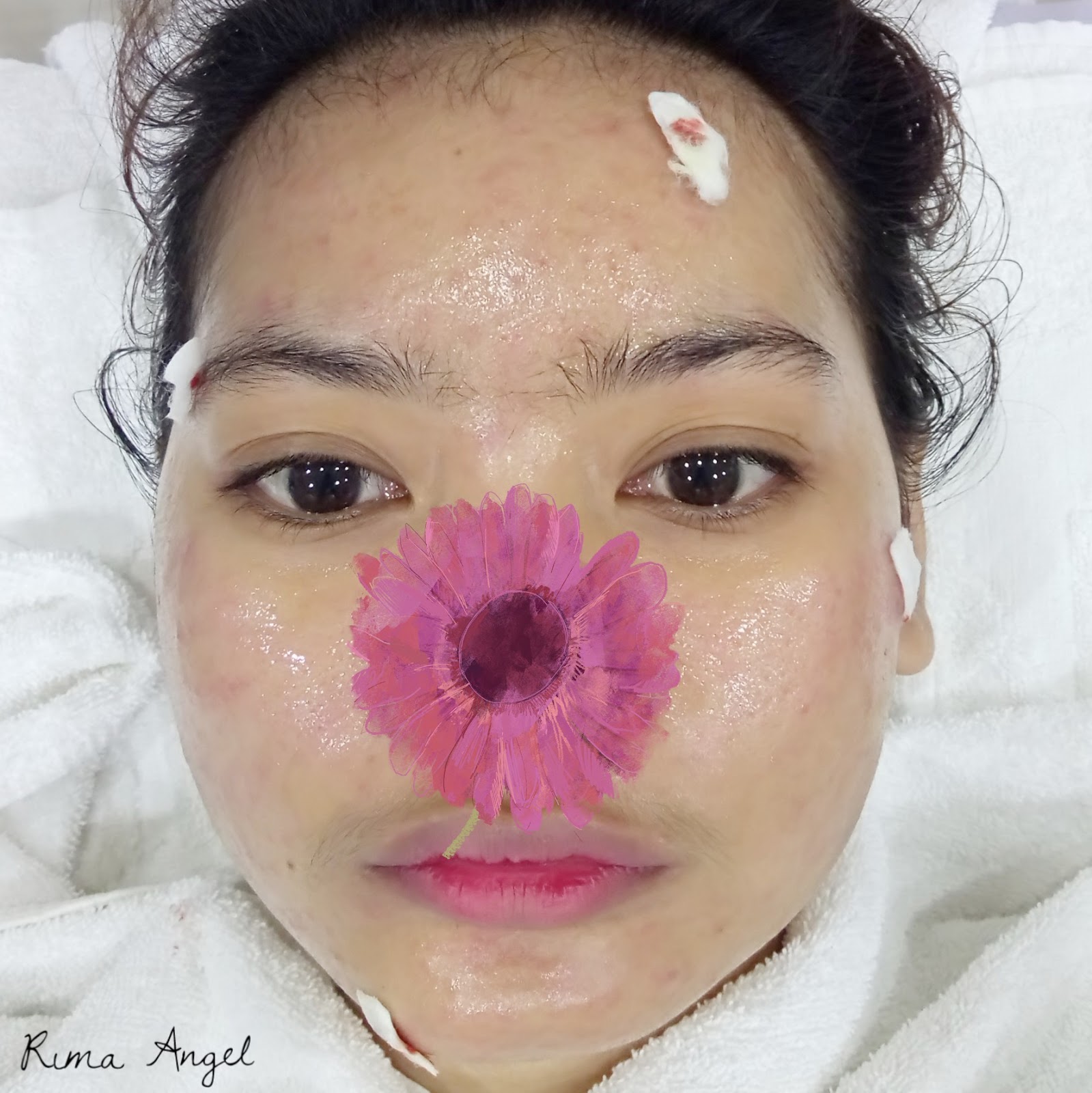 Pengalaman Suntik Jerawat