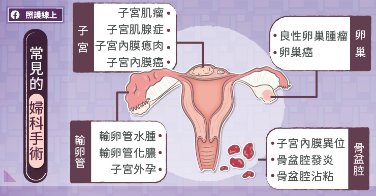 常見的婦科手術