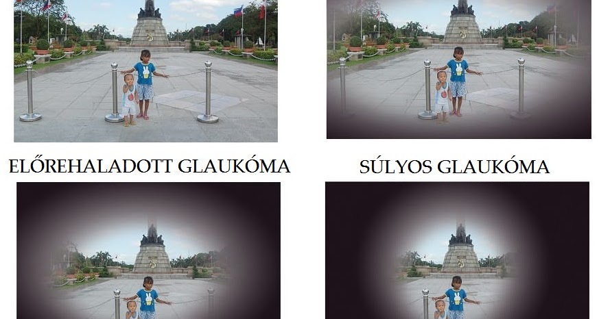 Zöldhályog tünetei, kezelése és okai (glaucoma) • jozsefistvan.hu