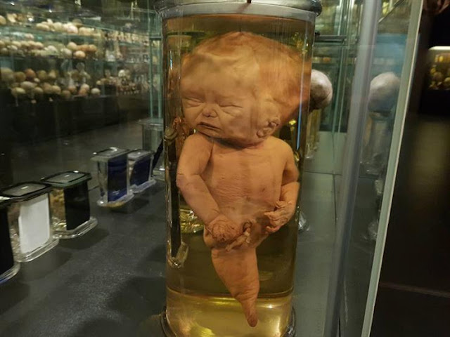 أجنة مشوهة في متحف بالقصر العيني أجنة مشوهة في متحف بالقصر العيني