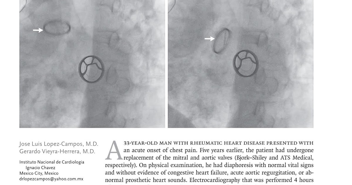 HÌNH ẢNH LÂM SÀNG VÀ CHẨN ĐOÁN HÌNH ẢNH ProstheticValve Dehiscence
