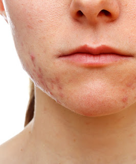 Acne En La Barbilla Acne En La Barbilla