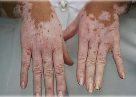 porque sale el vitiligo en las manos