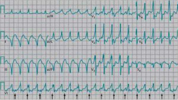 Ventricular tachycardia ECG